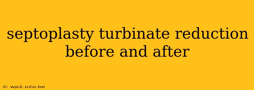 septoplasty turbinate reduction before and after